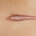 Understanding Keloid Scars: How to Identify and Treat Them