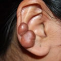 Understanding the Early Signs of Keloid Formation