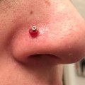 The Truth About Piercing Keloids: Do They Keep Growing?