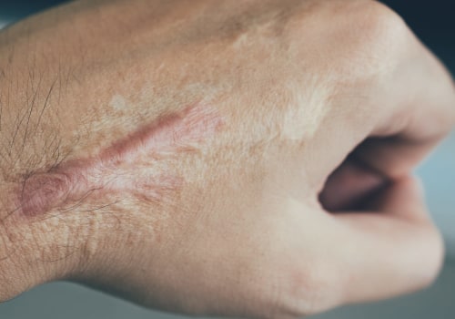 The Truth About Keloid Scars: Can They Really Go Away?