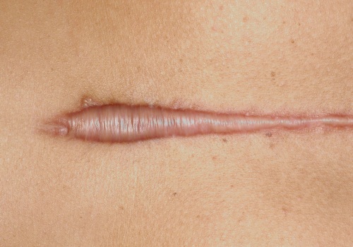 Understanding Keloid Scars: How to Identify and Treat Them