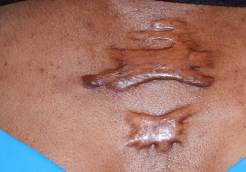 The Truth About Keloid Scars: Causes, Treatment, and Prevention