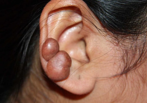 Understanding the Early Signs of Keloid Formation