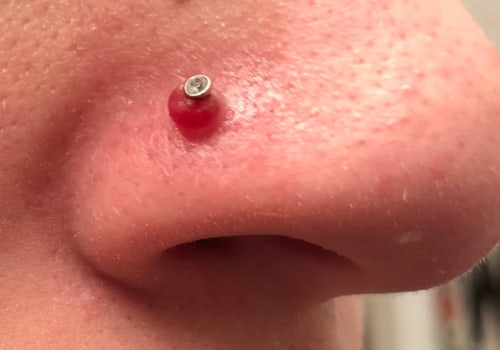 The Truth About Piercing Keloids: Do They Keep Growing?