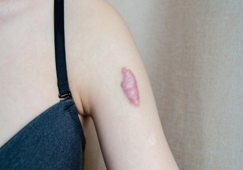 Flattening Keloid Scars: Expert Tips for Home Treatment