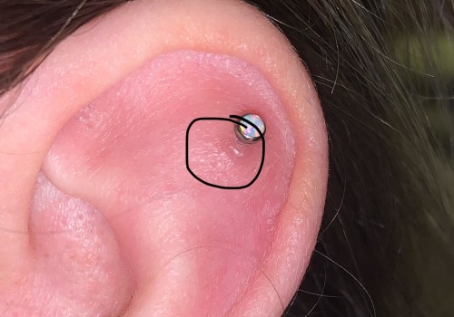 Understanding the Early Signs of Keloid Formation