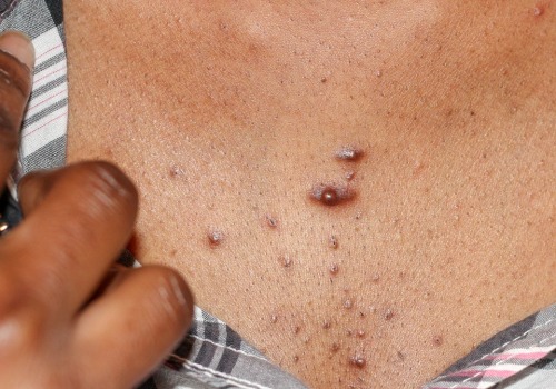 Understanding Keloid Scars: From an Expert's Perspective